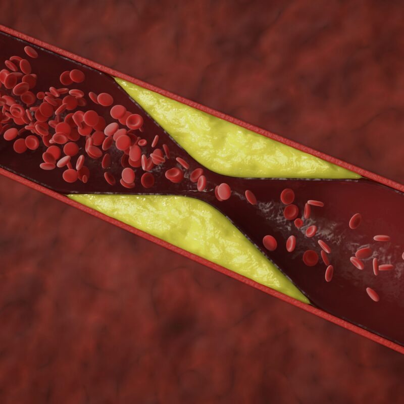 A cross-section of an artery shows a buildup of yellowish plaque narrowing the vessel, with red blood cells flowing through the constricted space, illustrating atherosclerosis from high cholesterol levels.